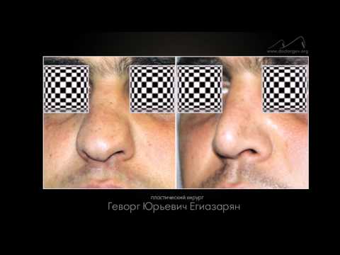 Фотогалерея "До и после ринопластики"